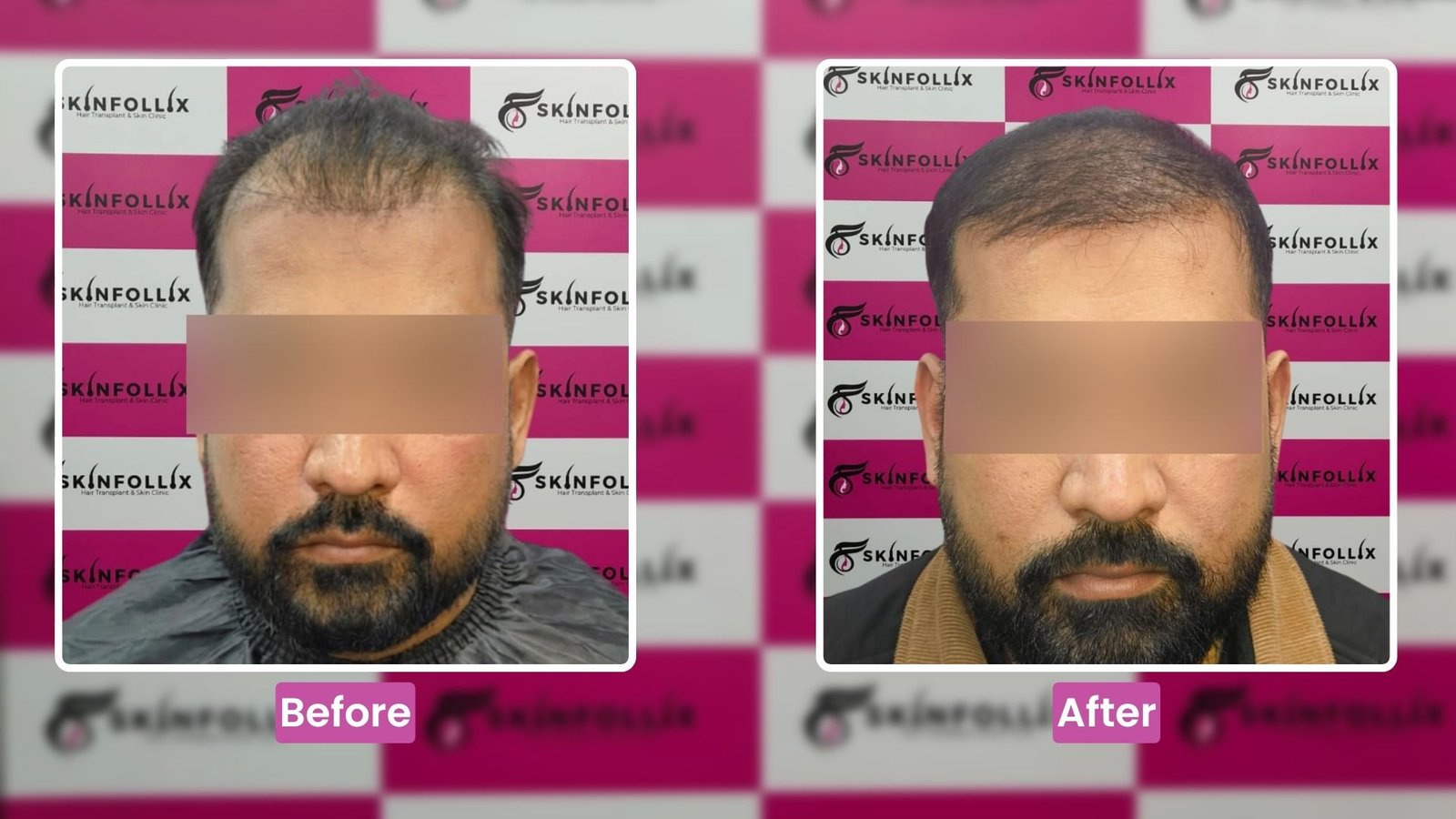 hair-transplant-result-1