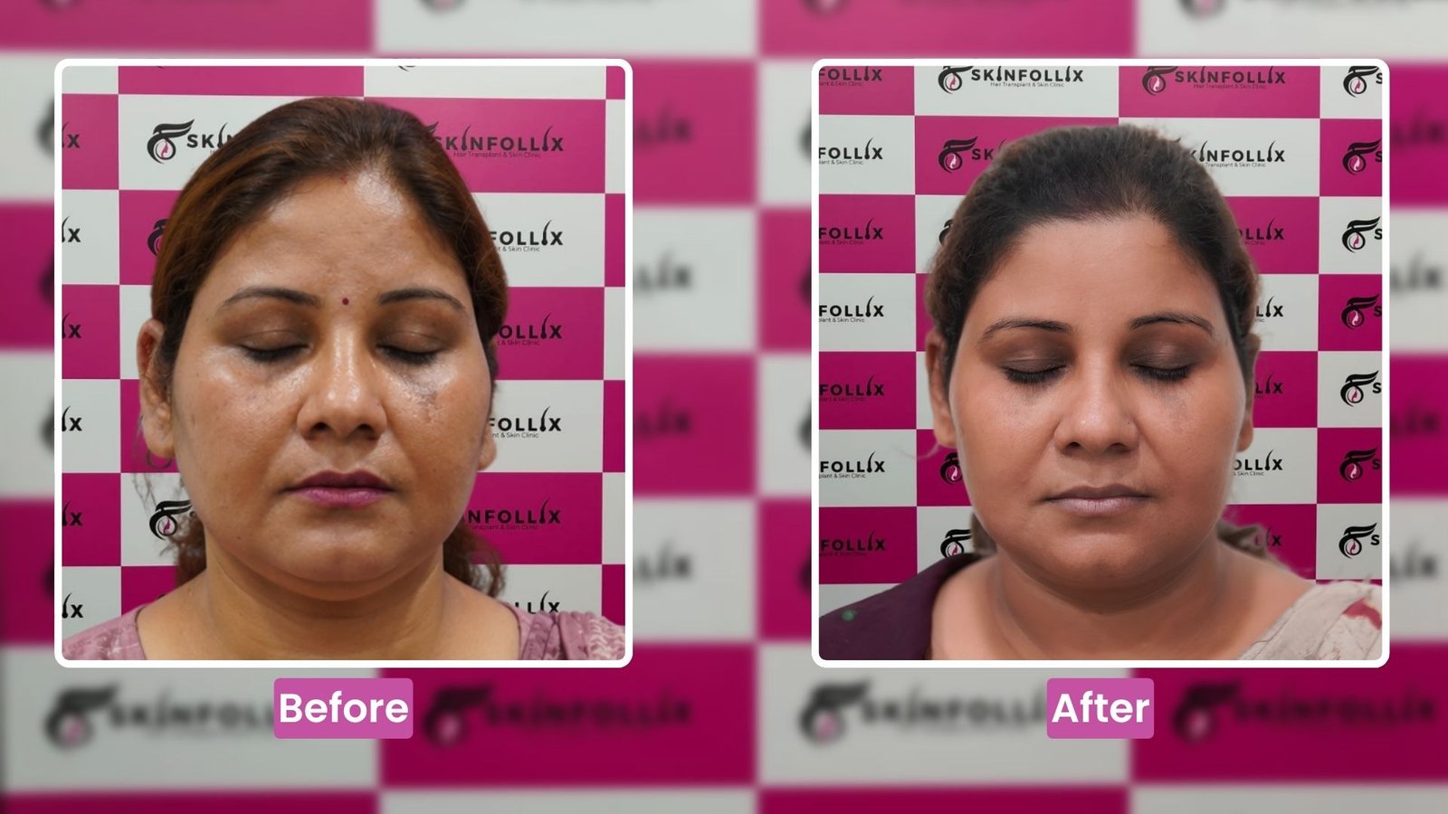 hair-transplant-result-2