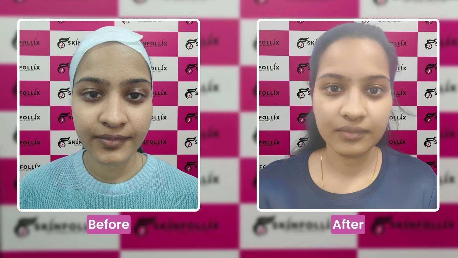 hair-transplant-result-3