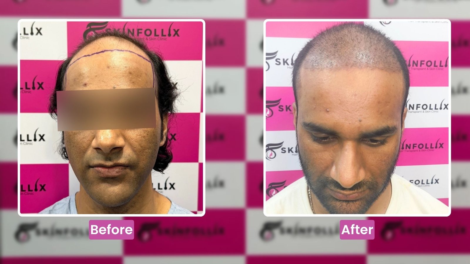 hair-transplant-result-4