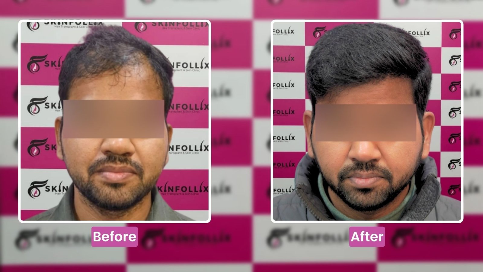 hair-transplant-result-5
