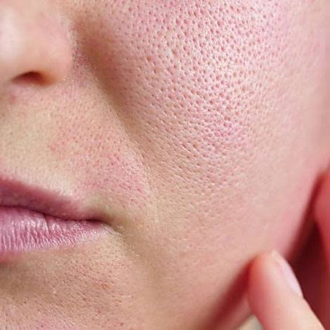 Open pores and enlarged pores on facial skin