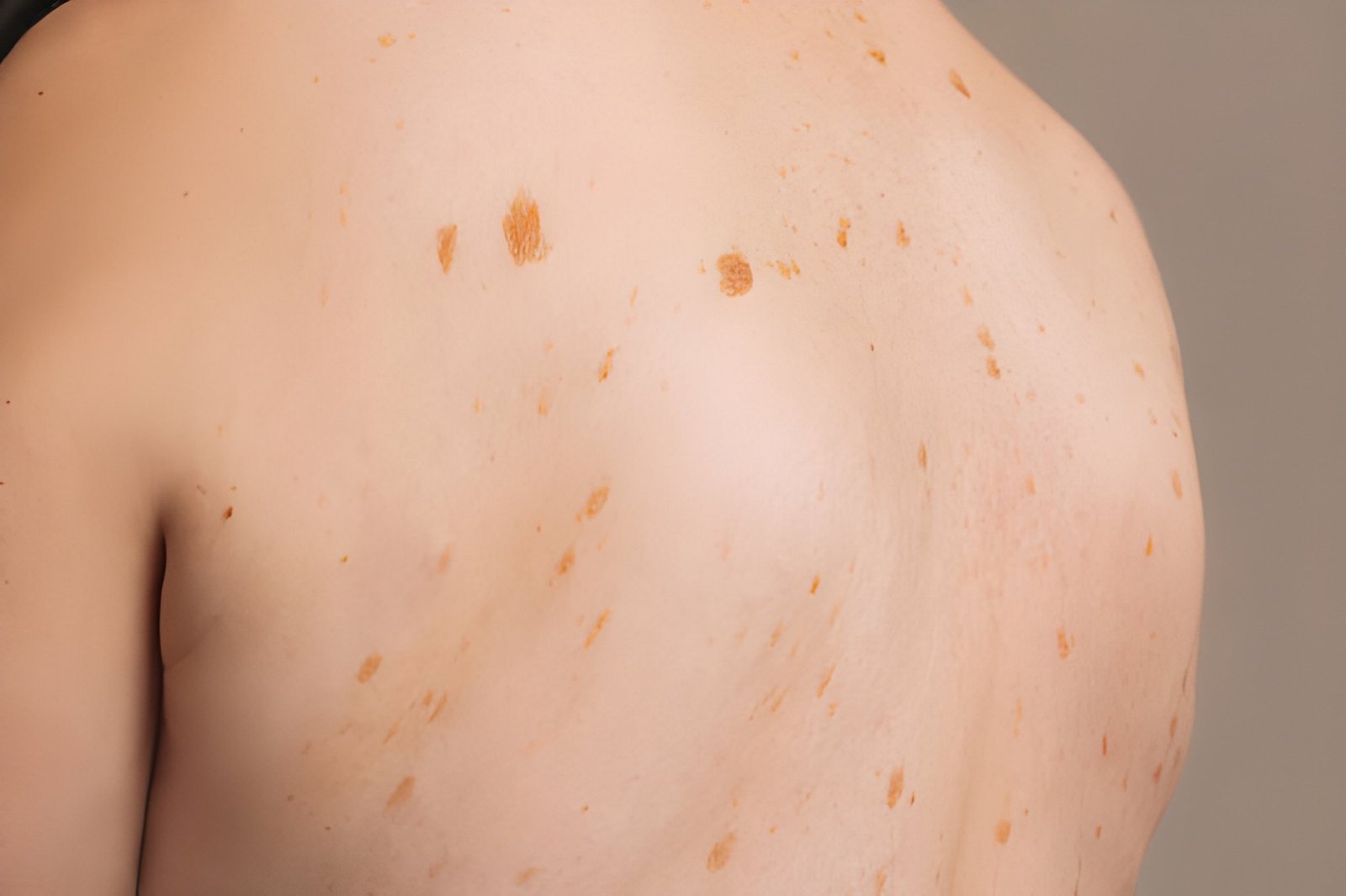 Skin-coloured and pigmented moles assessed in Delhi