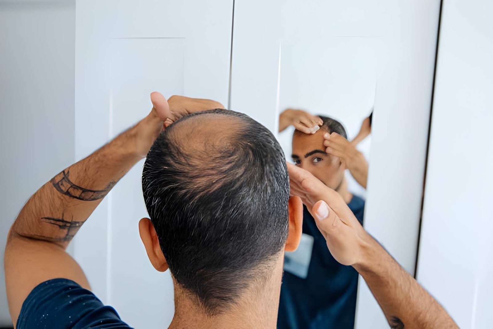 Telogen effluvium diffuse hair shedding treatment at Skinfollix, hair clinic in Delhi
