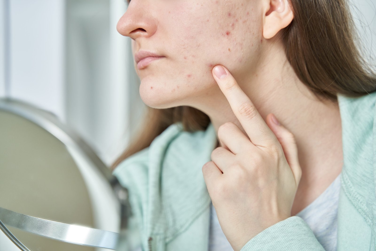 Acne treatment by Dr. Vijay Soyal, dermatologist in Delhi