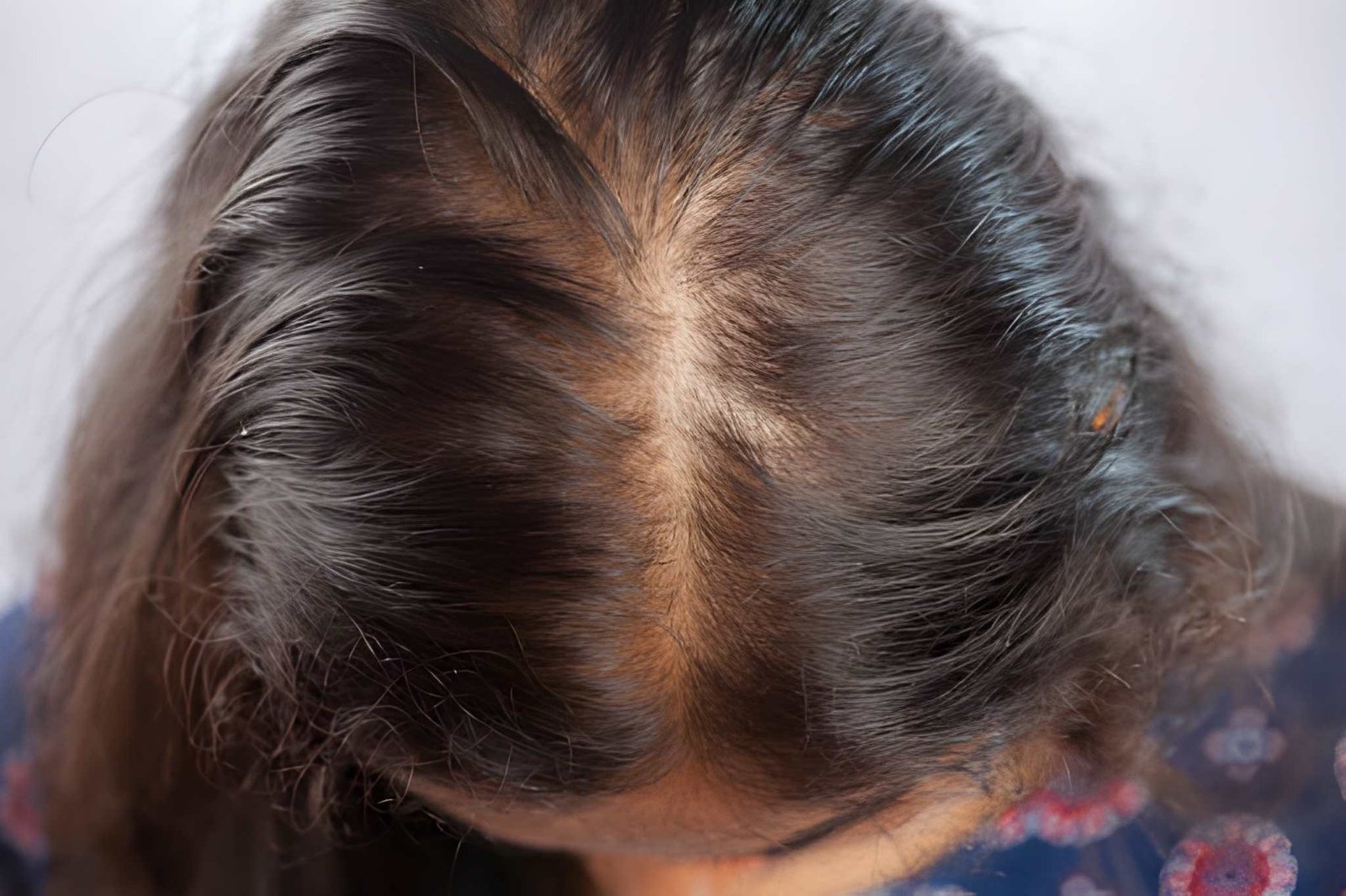Alopecia treatment in Delhi