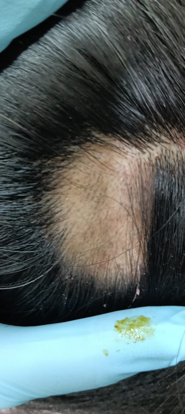 Alopecia areata treatment in Delhi at Skinfollix