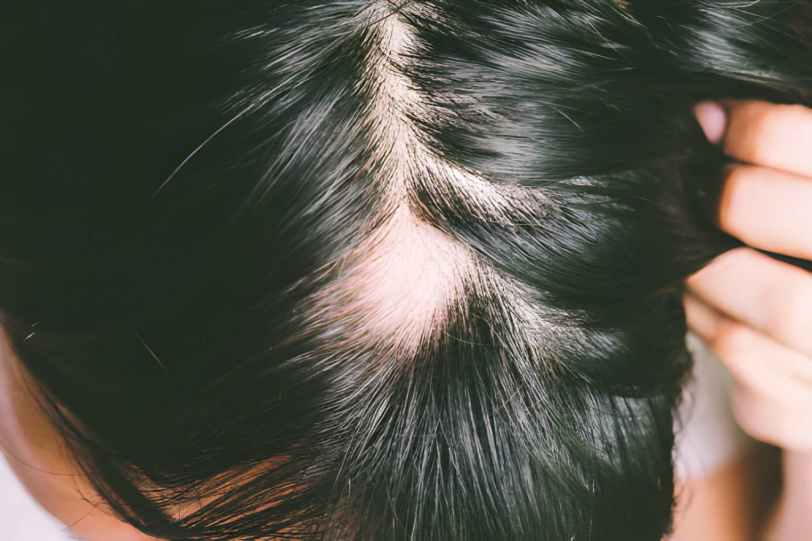 Androgenetic alopecia causing gradual pattern hair thinning