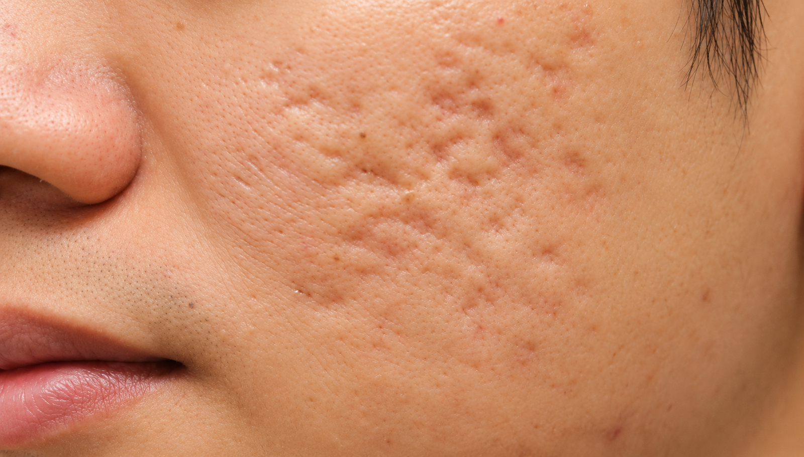 Laser scar treatment for boxcar scars in Delhi at Skinfollix