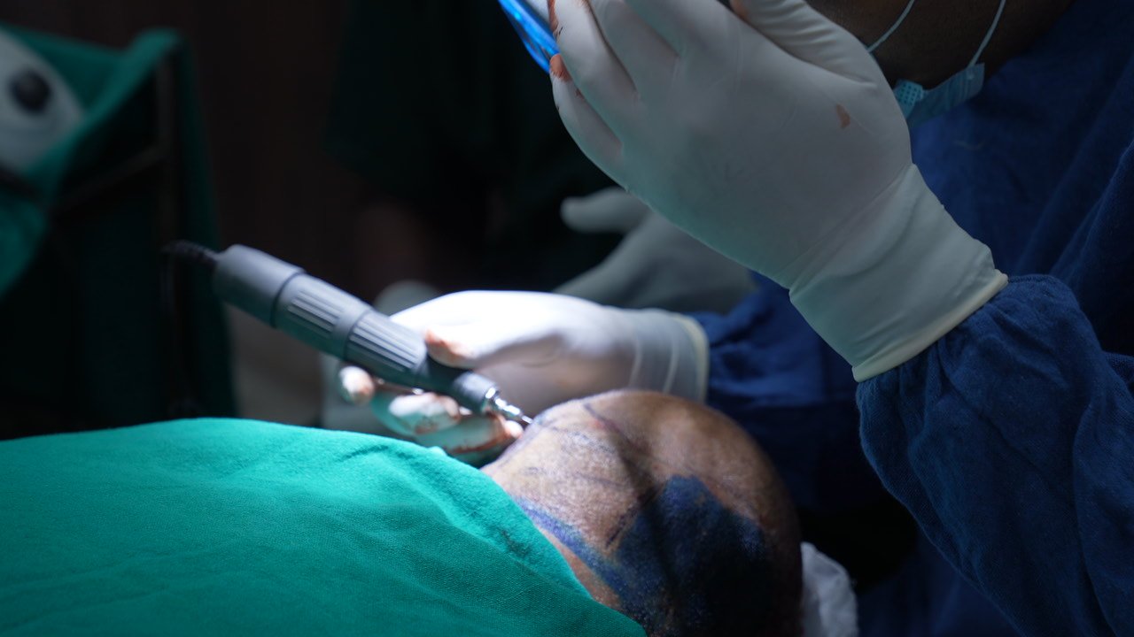 Combination hair loss treatment for men with male pattern baldness in Delhi