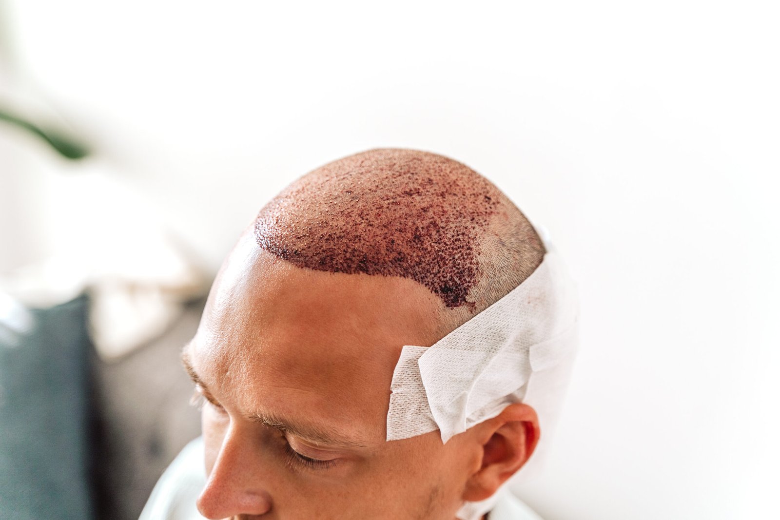 DHI hair transplant in Delhi at Skinfollix
