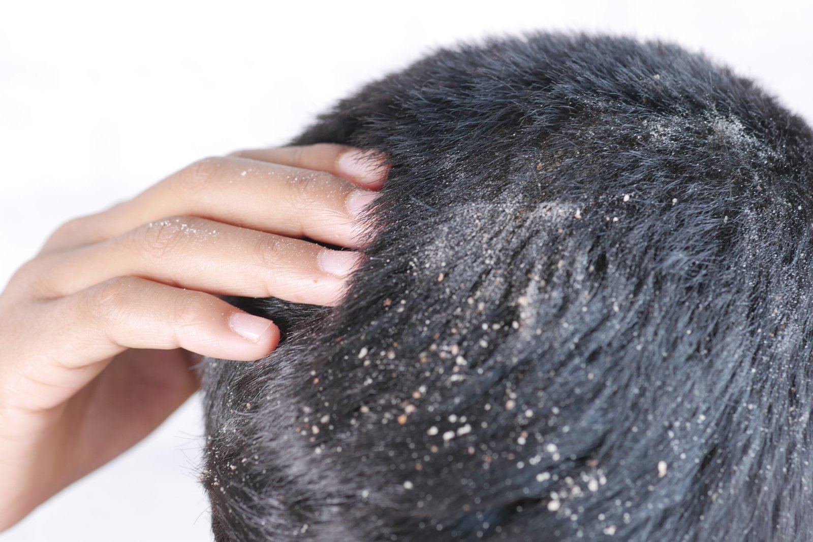 Dandruff Diagnosis At Skinfollix
