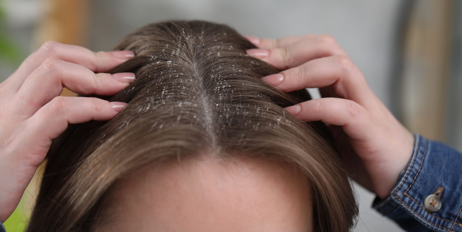 Dandruff Treatment in Delhi