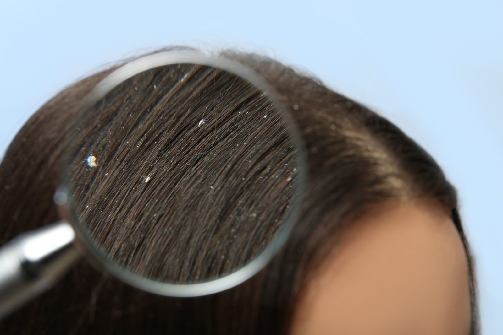 Dandruff with visible scalp flakes
