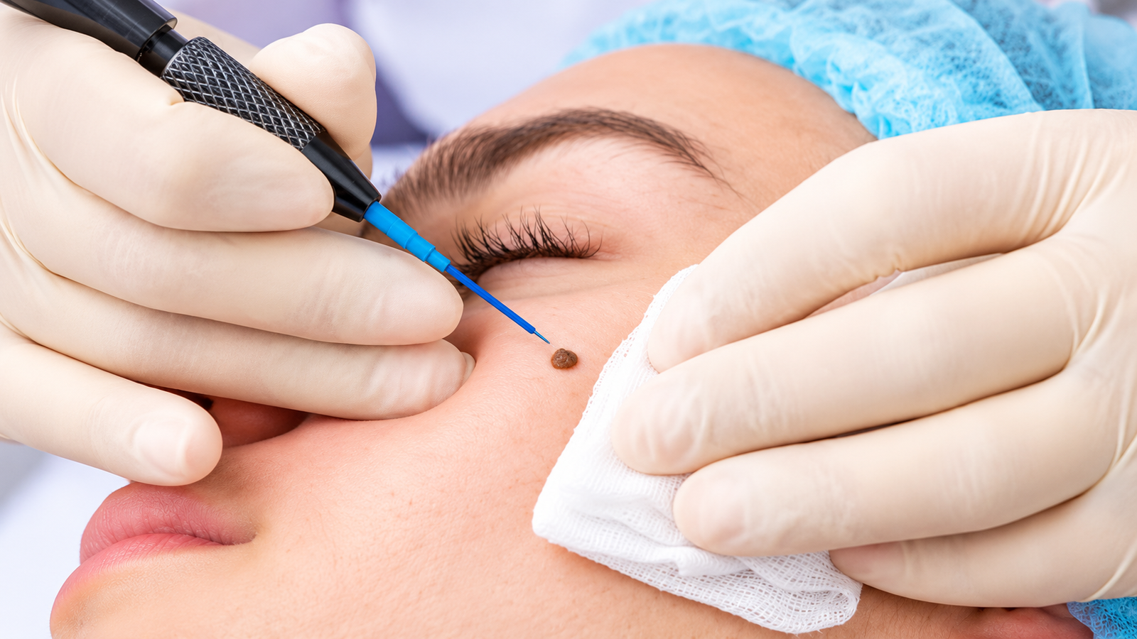 Dermatologist assessing skin before laser mole removal for Indian skin at Skinfollix in Delhi