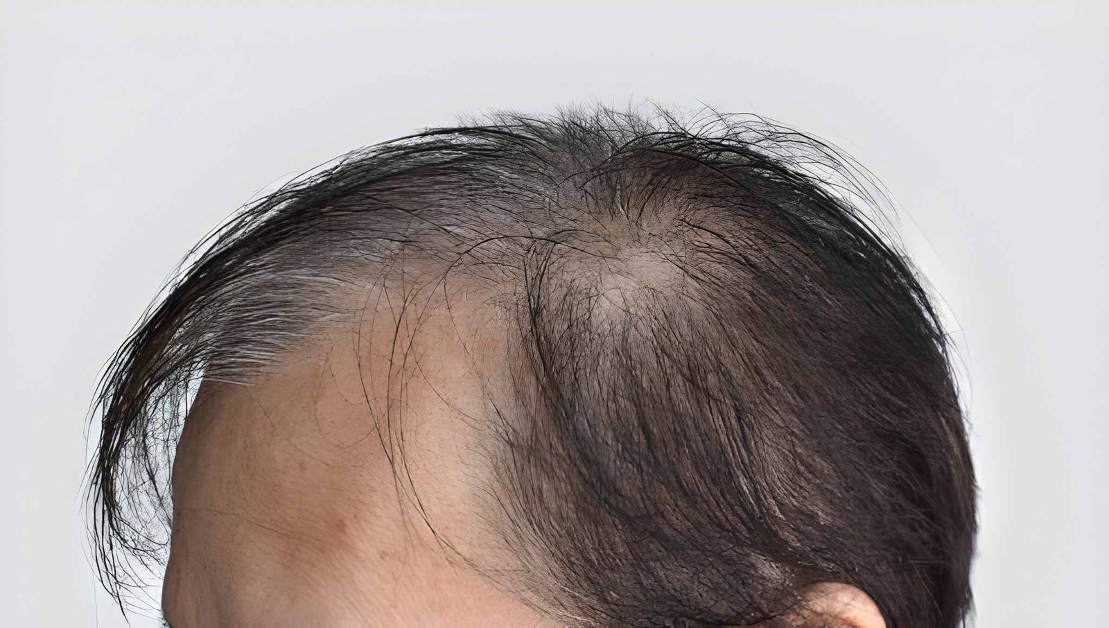 Diffuse thinning pattern in male pattern baldness