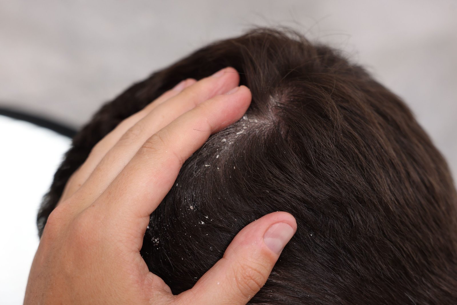 Dry scalp with visible flakes