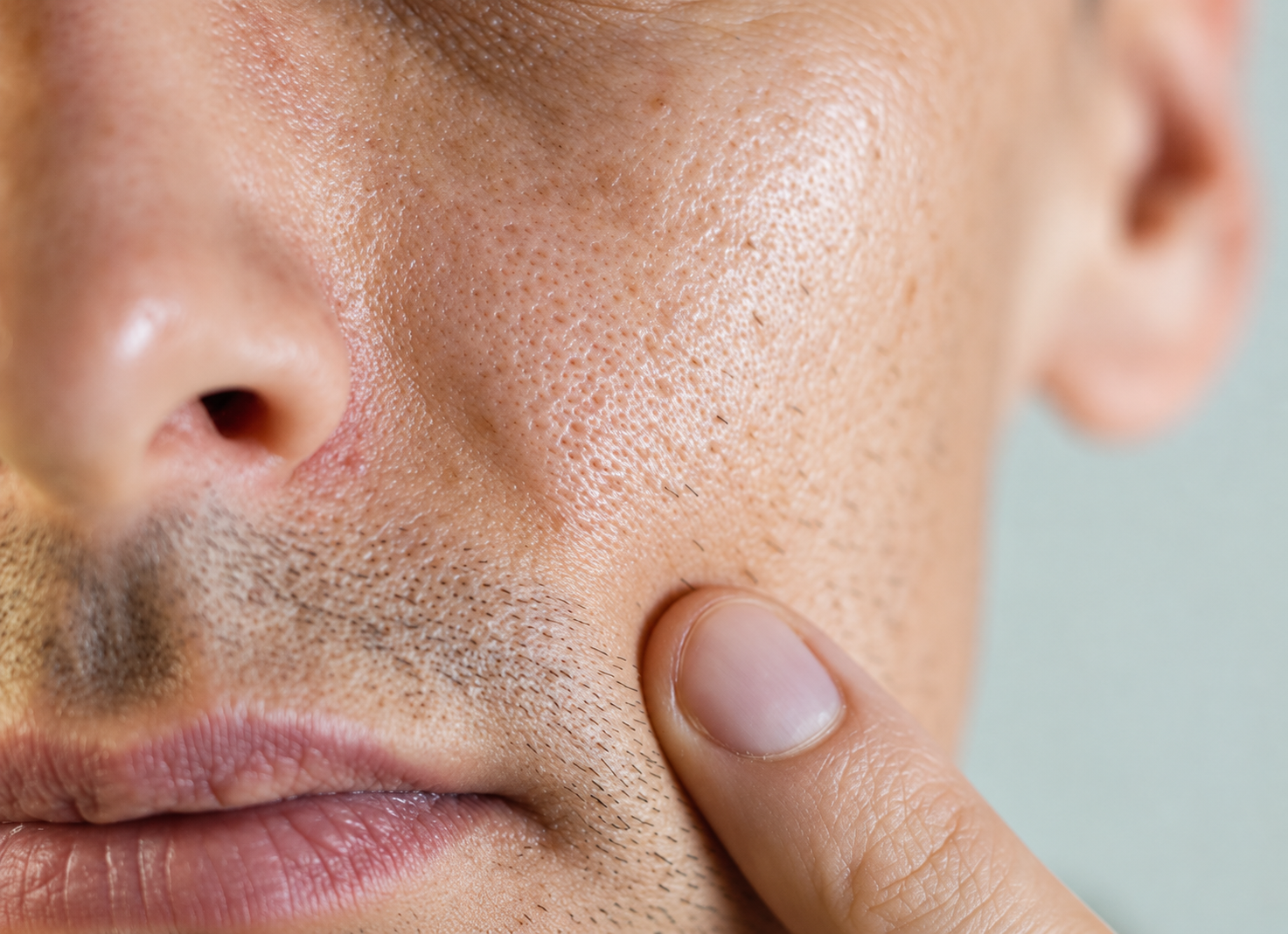 Laser skin pigmentation treatment for enlarged pores in Delhi at Skinfollix