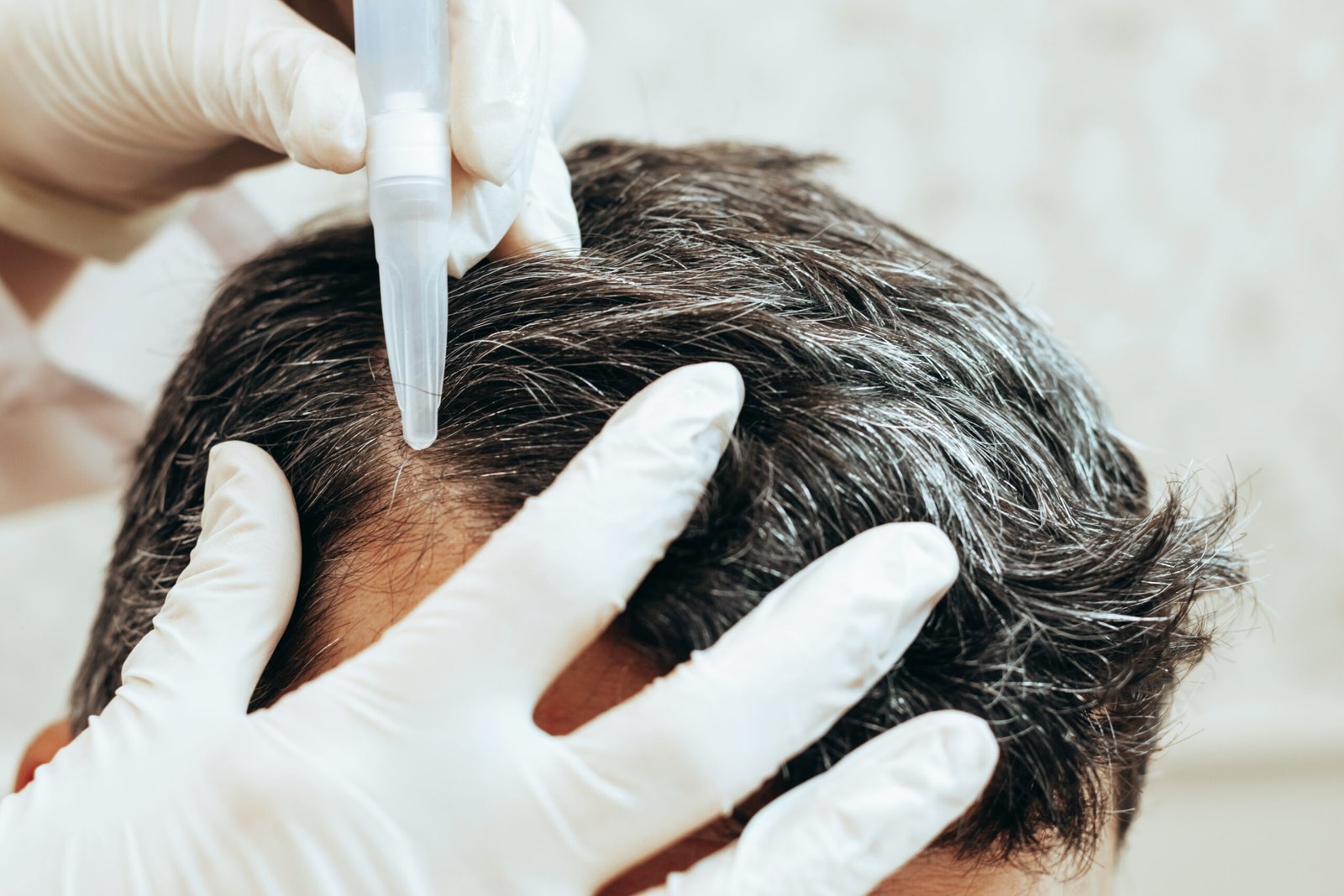 FUT hair transplant in Delhi at Skinfollix