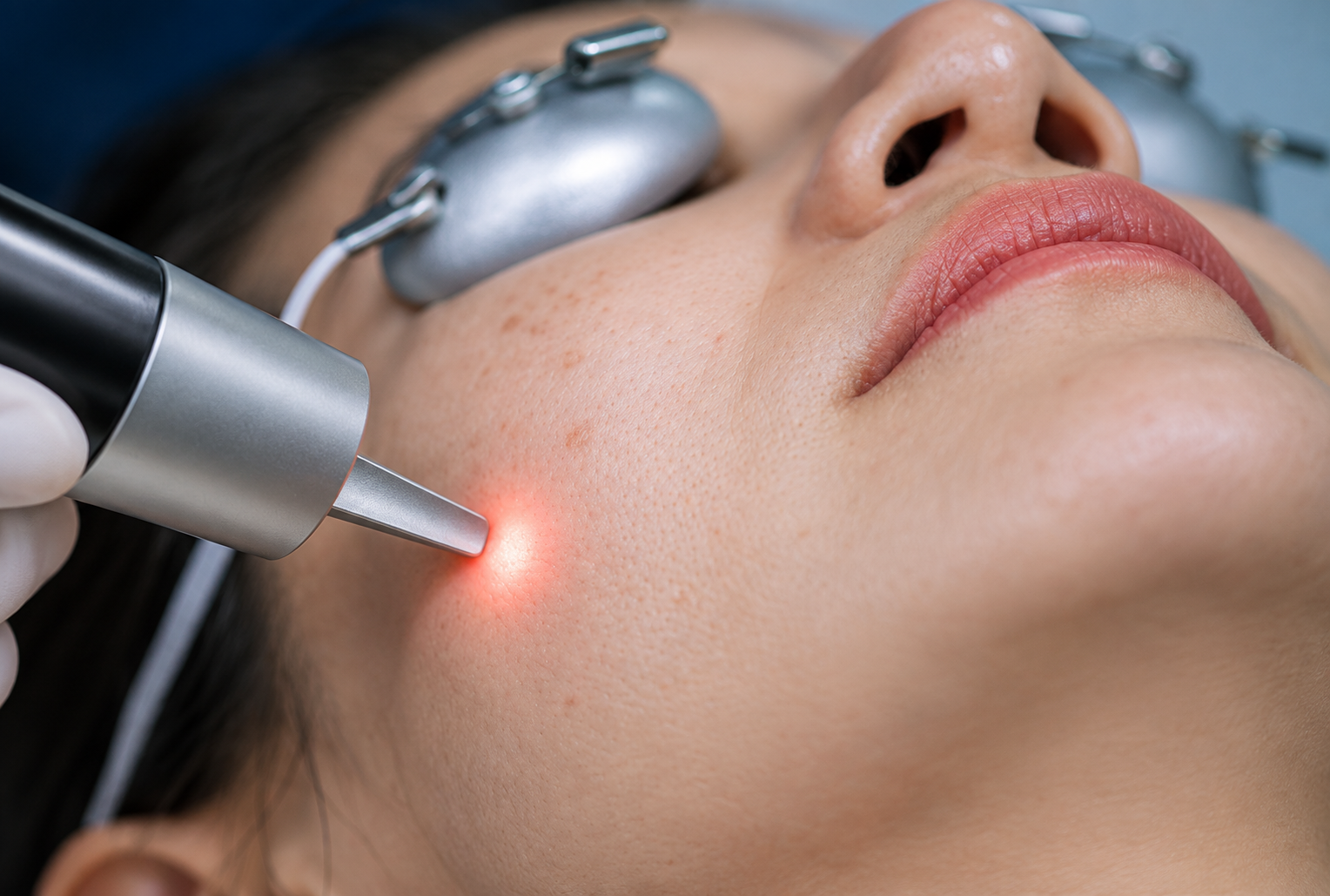 Laser skin pigmentation treatment for pigmentation in Delhi at Skinfollix