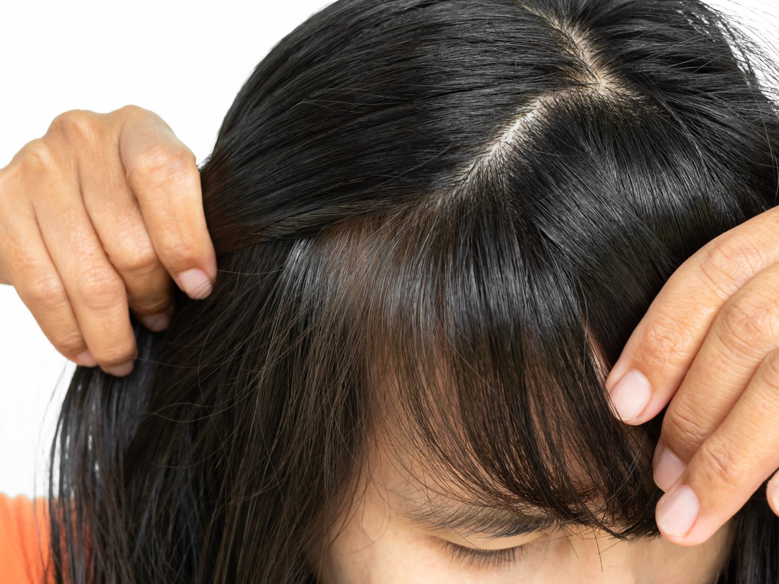 GFC hair treatment for patients sensitive to standard PRP injections