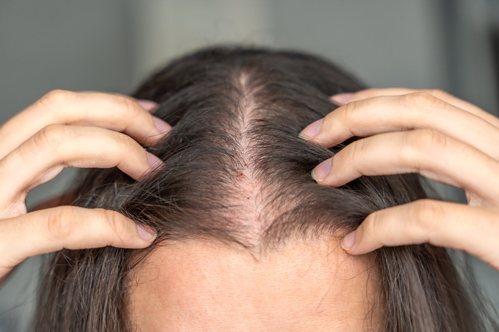 Hair regrowth treatment in Delhi at Skinfollix