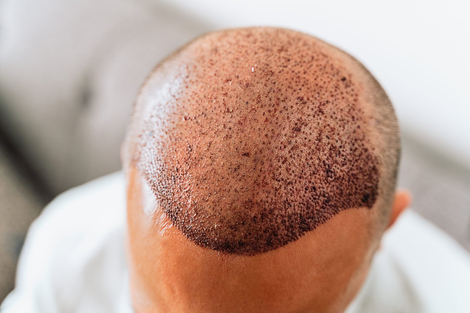 Hair loss treatment in Delhi at Skinfollix