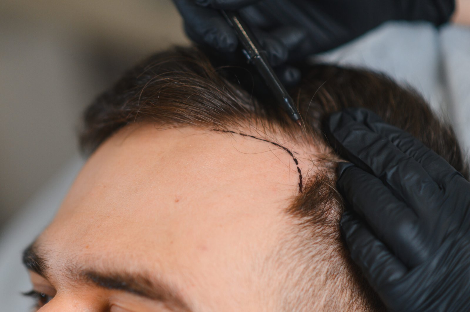 Hairline reconstruction in Delhi at Skinfollix