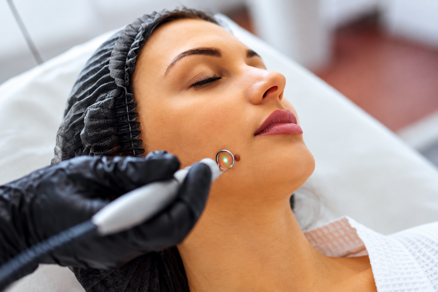 How laser mole removal works at Skinfollix, Delhi