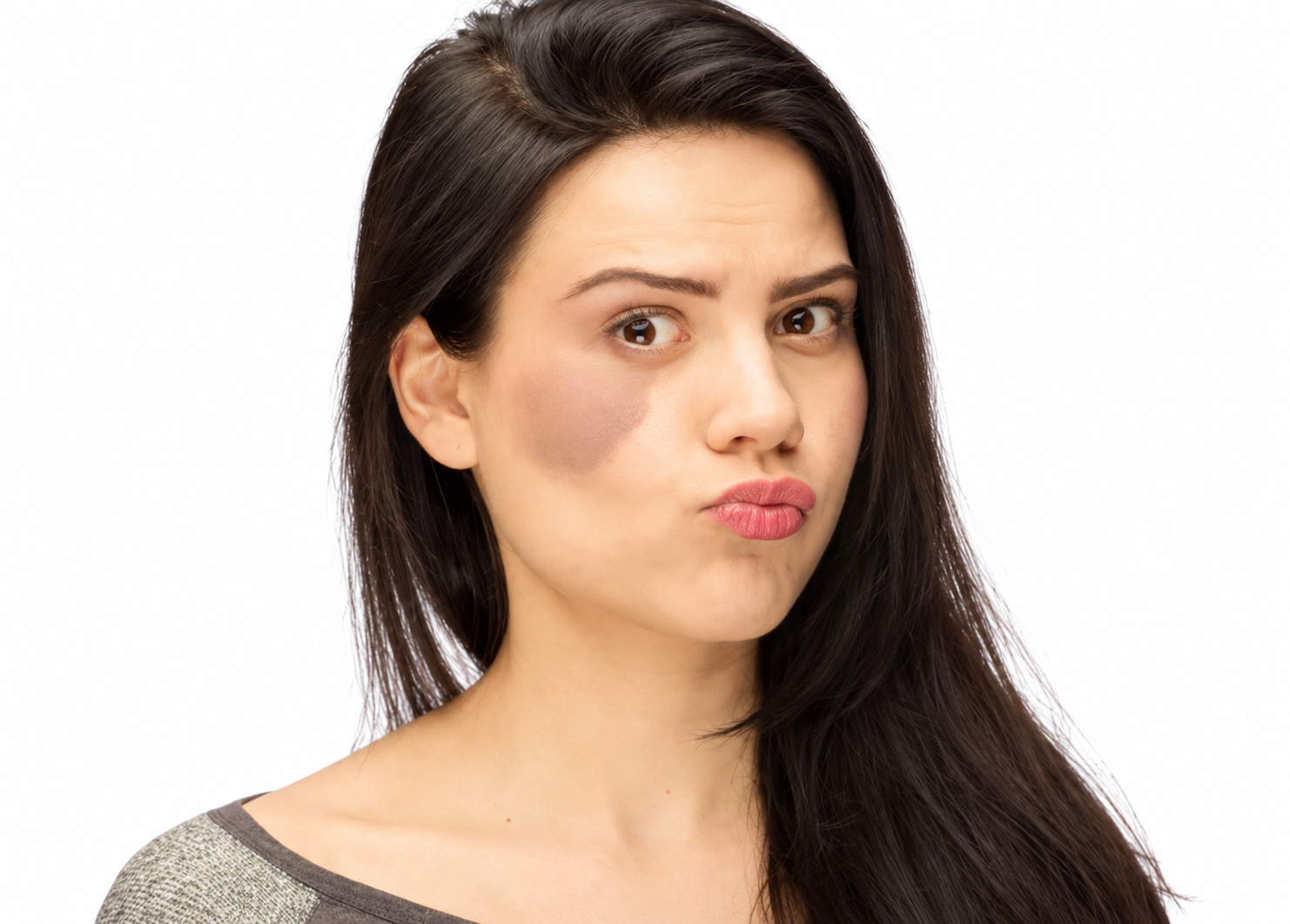 Laser birthmark removal in Delhi at Skinfollix Dermatology Clinic