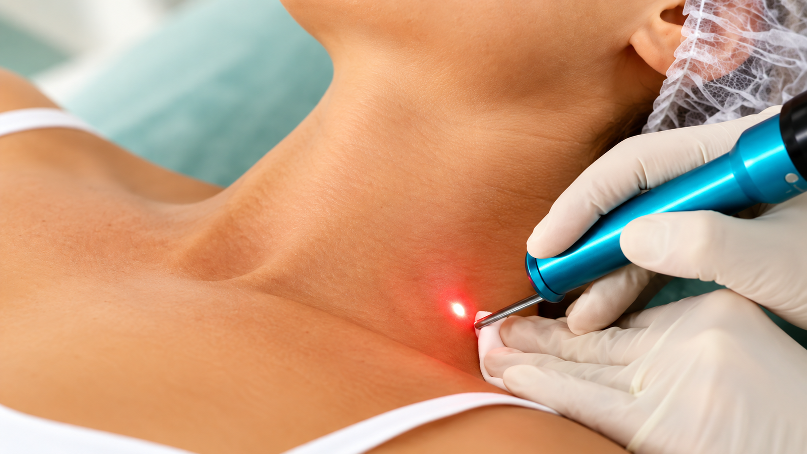 Laser mole removal in Delhi at Skinfollix Dermatology Clinic