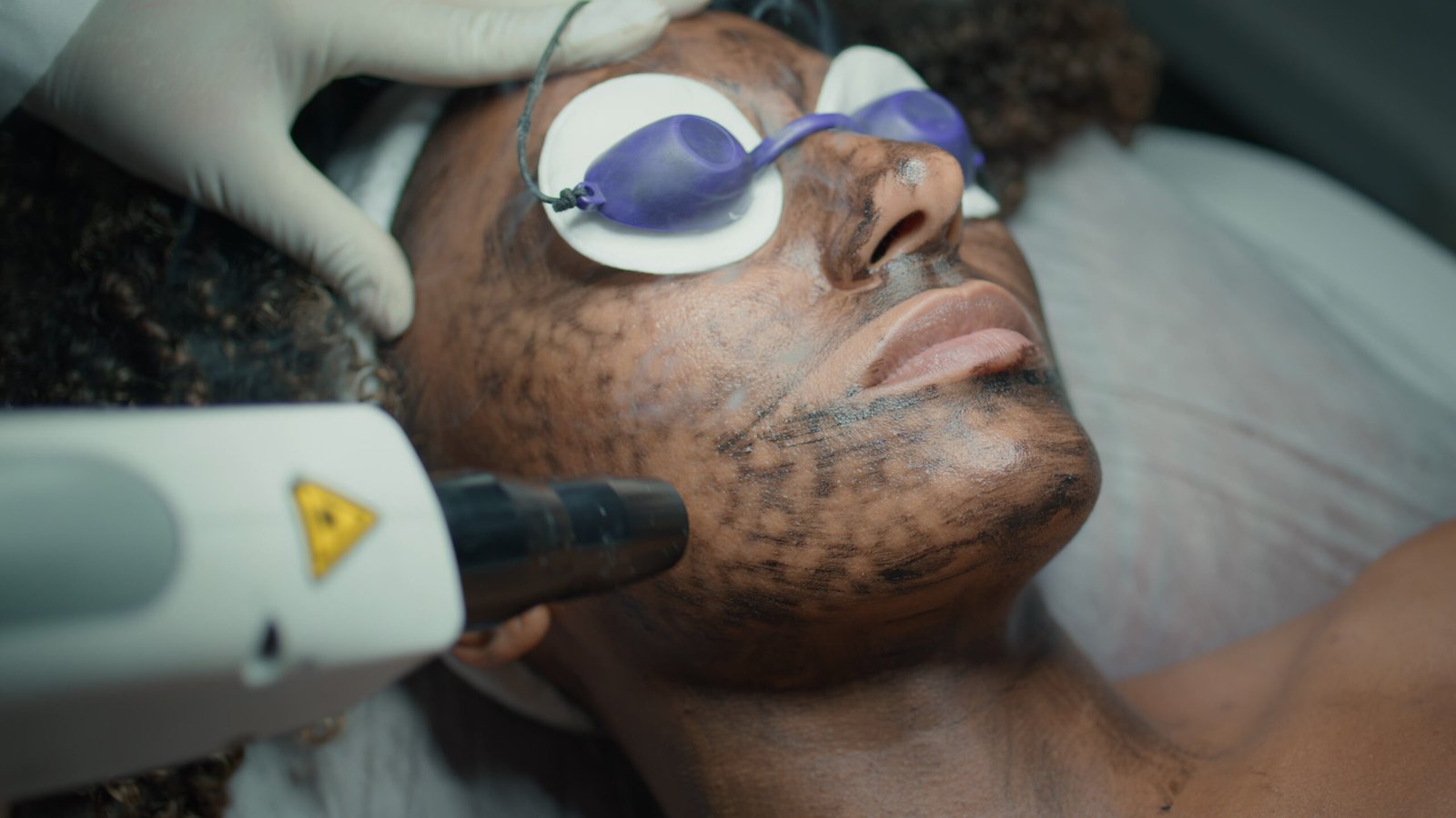 Laser pigmentation treatment by Dr. Vijay Soyal, dermatologist in Delhi