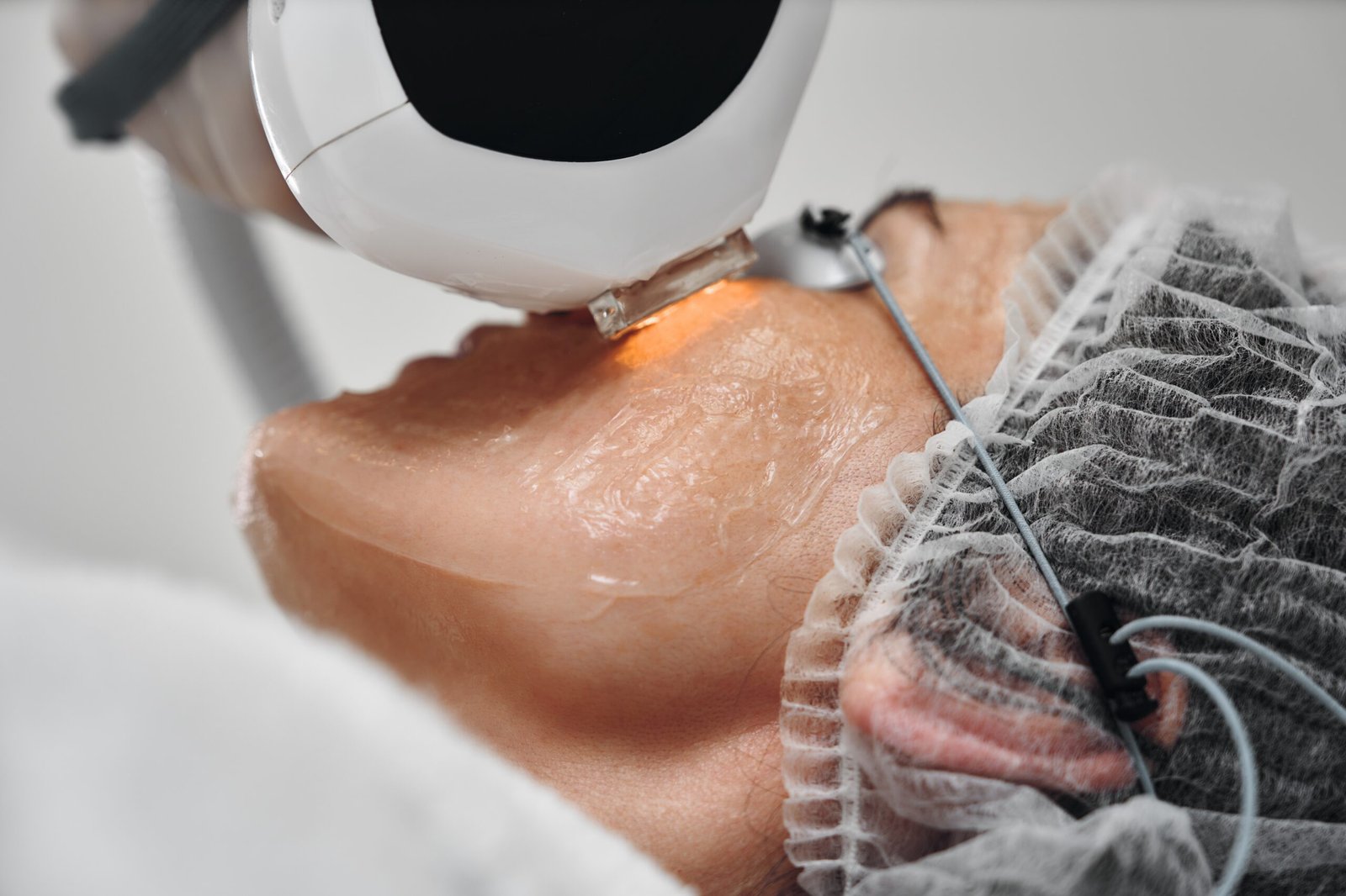 Laser skin resurfacing by Dr. Vijay Soyal, dermatologist in Delhi