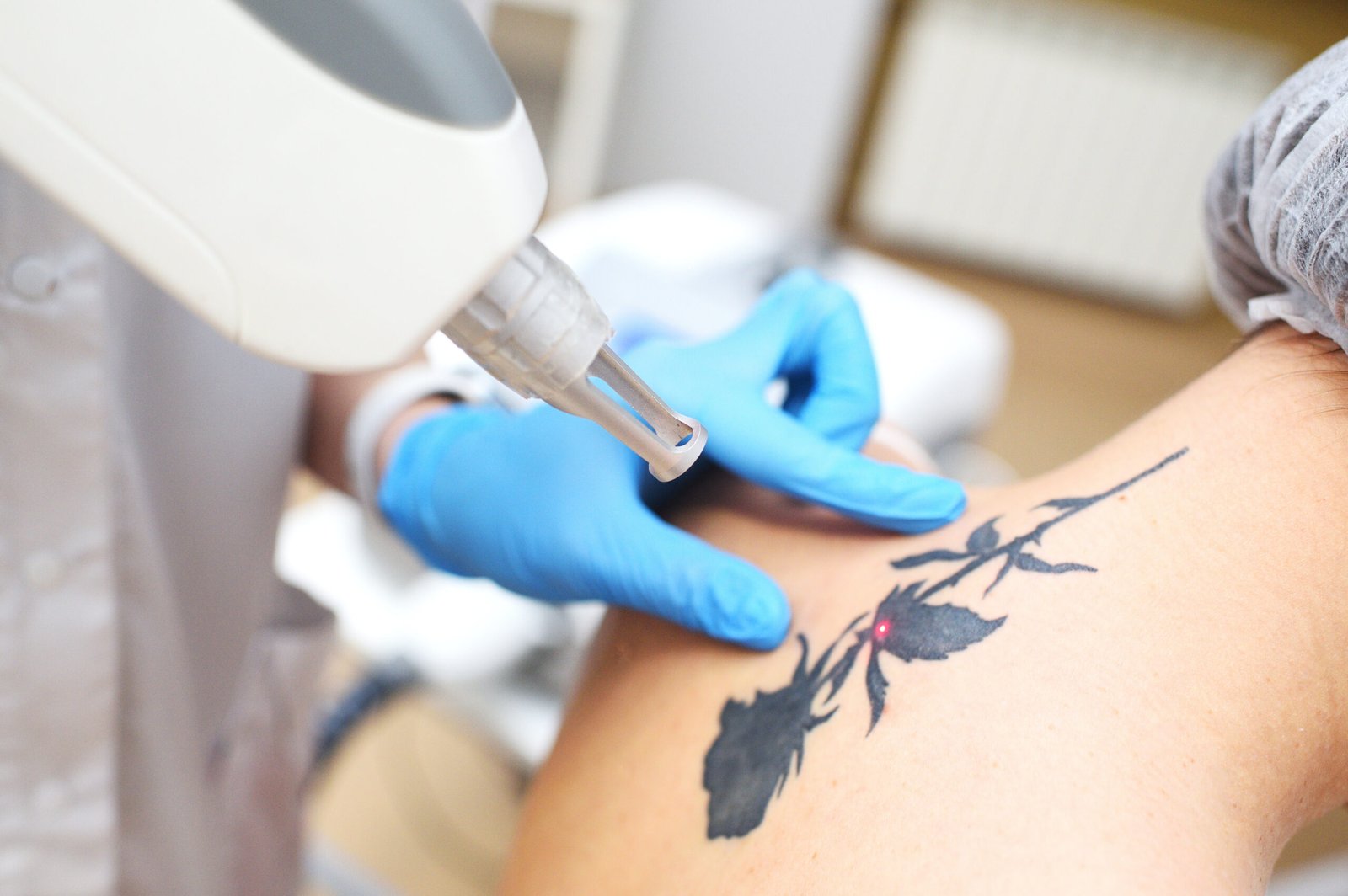 Laser tattoo removal by Dr. Vijay Soyal, dermatologist in Delhi
