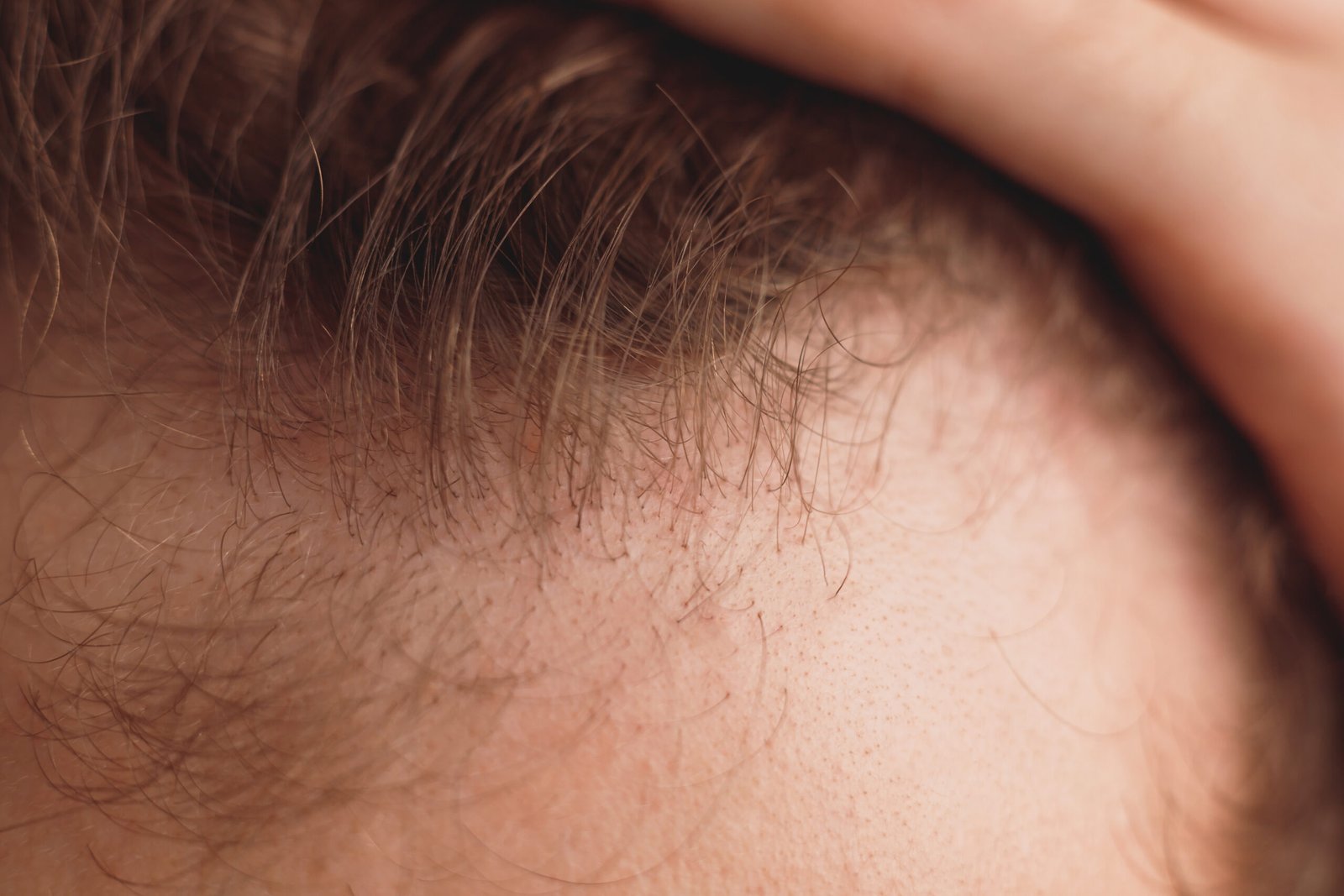 Limited response to standard PRP before GFC hair treatment