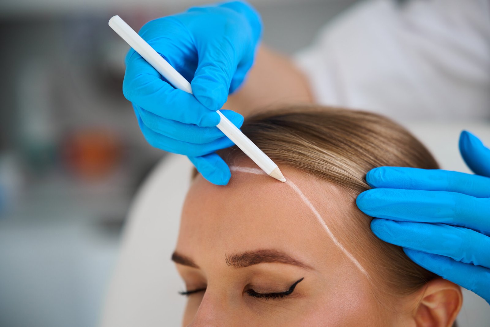 Long-hair FUE transplant in Delhi at Skinfollix