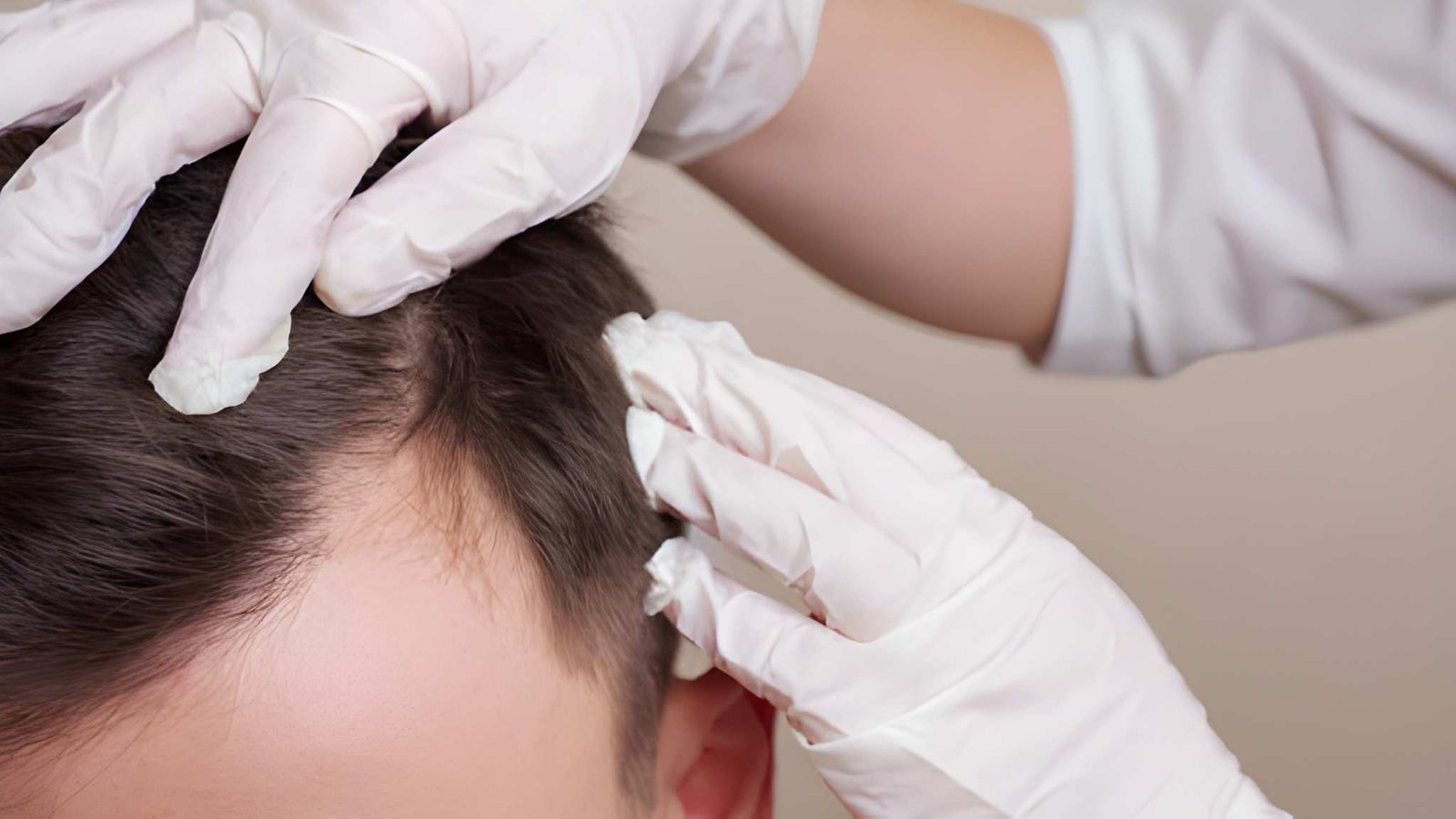 Long-term dandruff management in Delhi