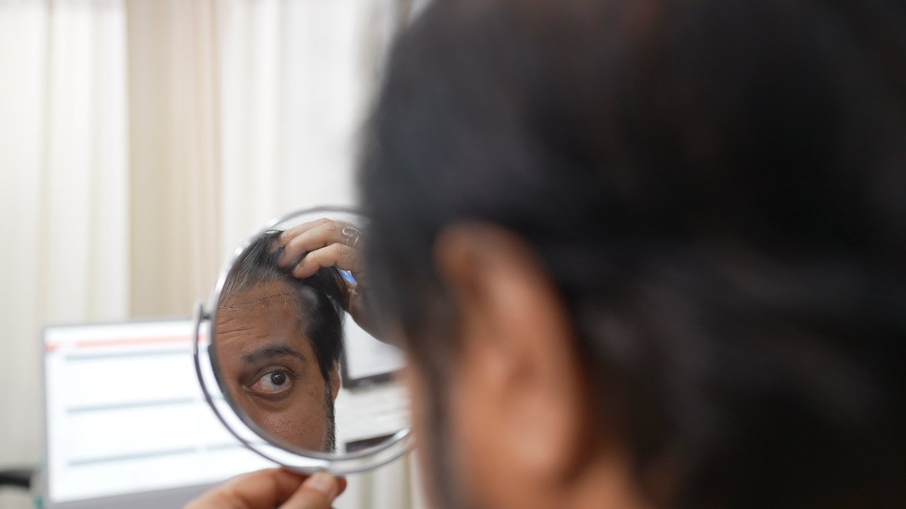 man consulting an alopecia dermatologist in Delhi about sudden patchy hair loss