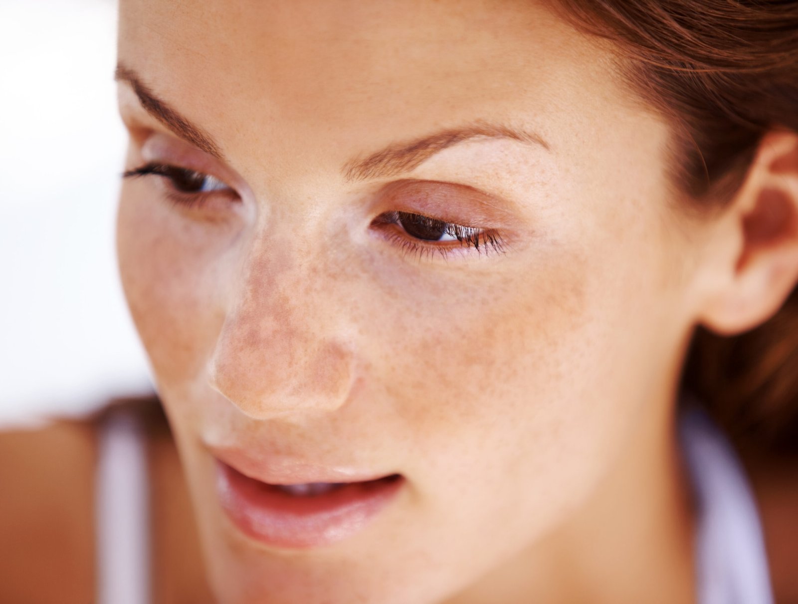 Melasma treatment by Dr. Vijay Soyal, dermatologist in Delhi