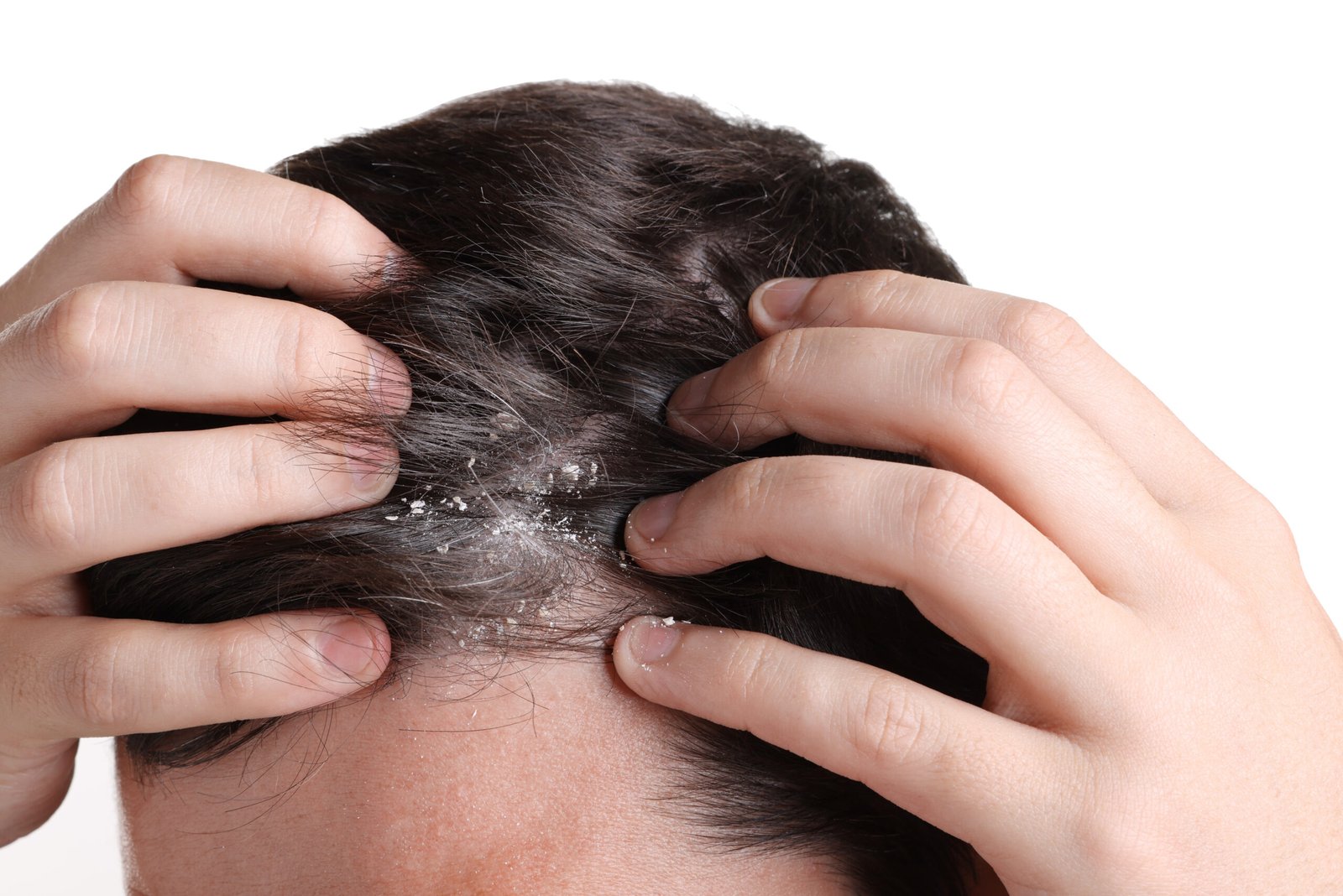 Oily scalp with dandruff flakes