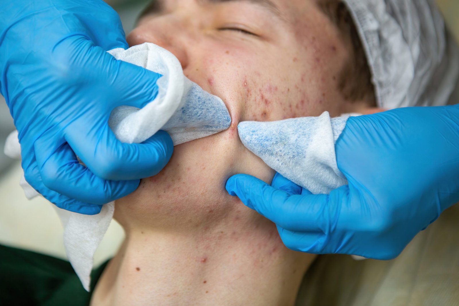Open pores treatment by Dr. Vijay Soyal, dermatologist in Delhi