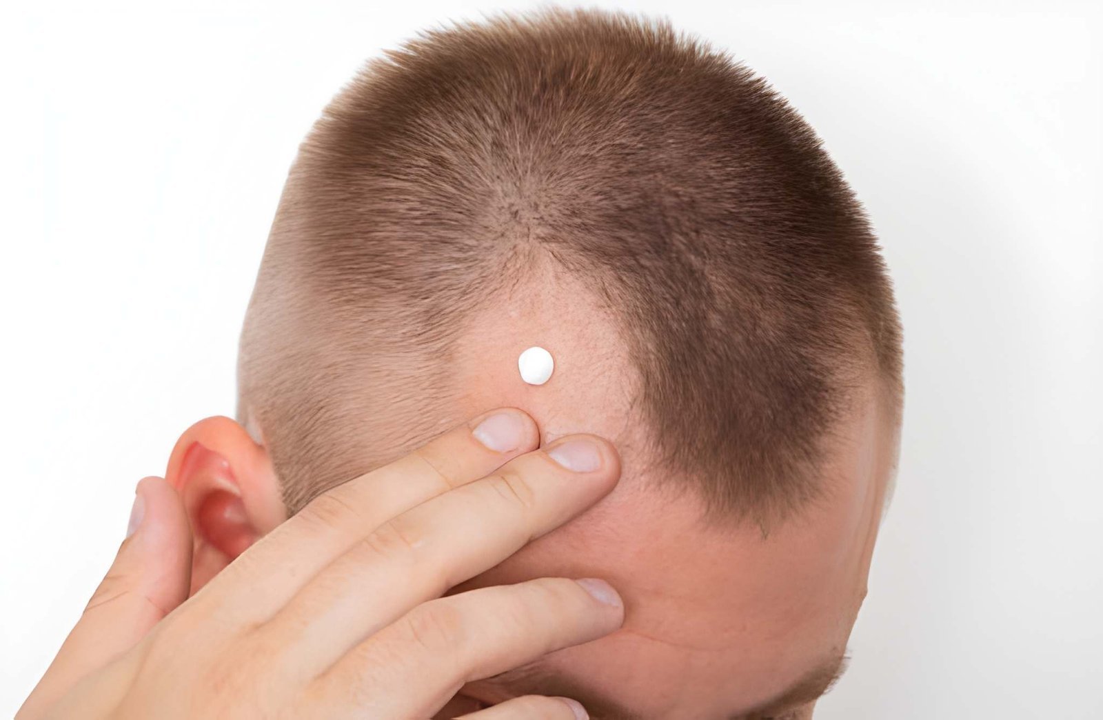 Topical and oral medical management for hair regrowth in Delhi
