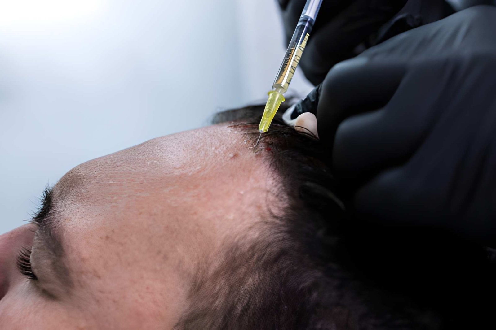 PRP hair treatment for hair regrowth in Delhi at Skinfollix