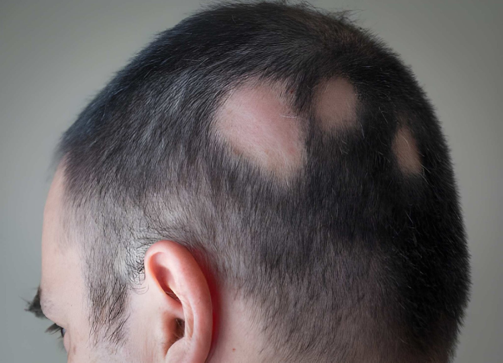 Single patch alopecia areata causing a smooth bald spot