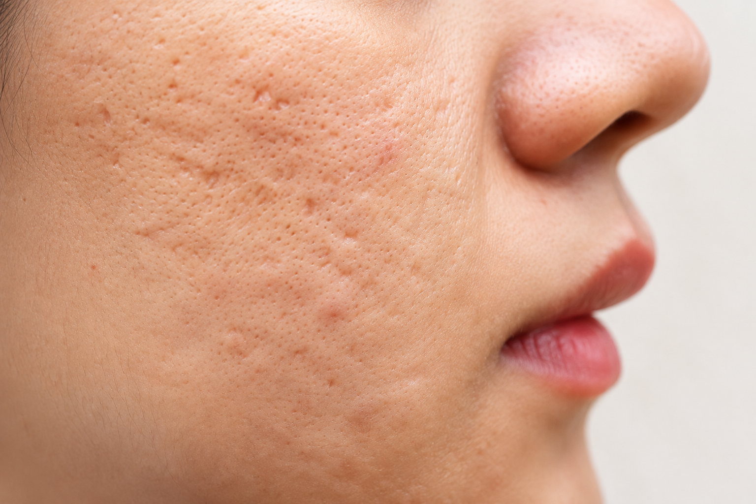 Laser scar treatment for pitted acne scars in Delhi at Skinfollix