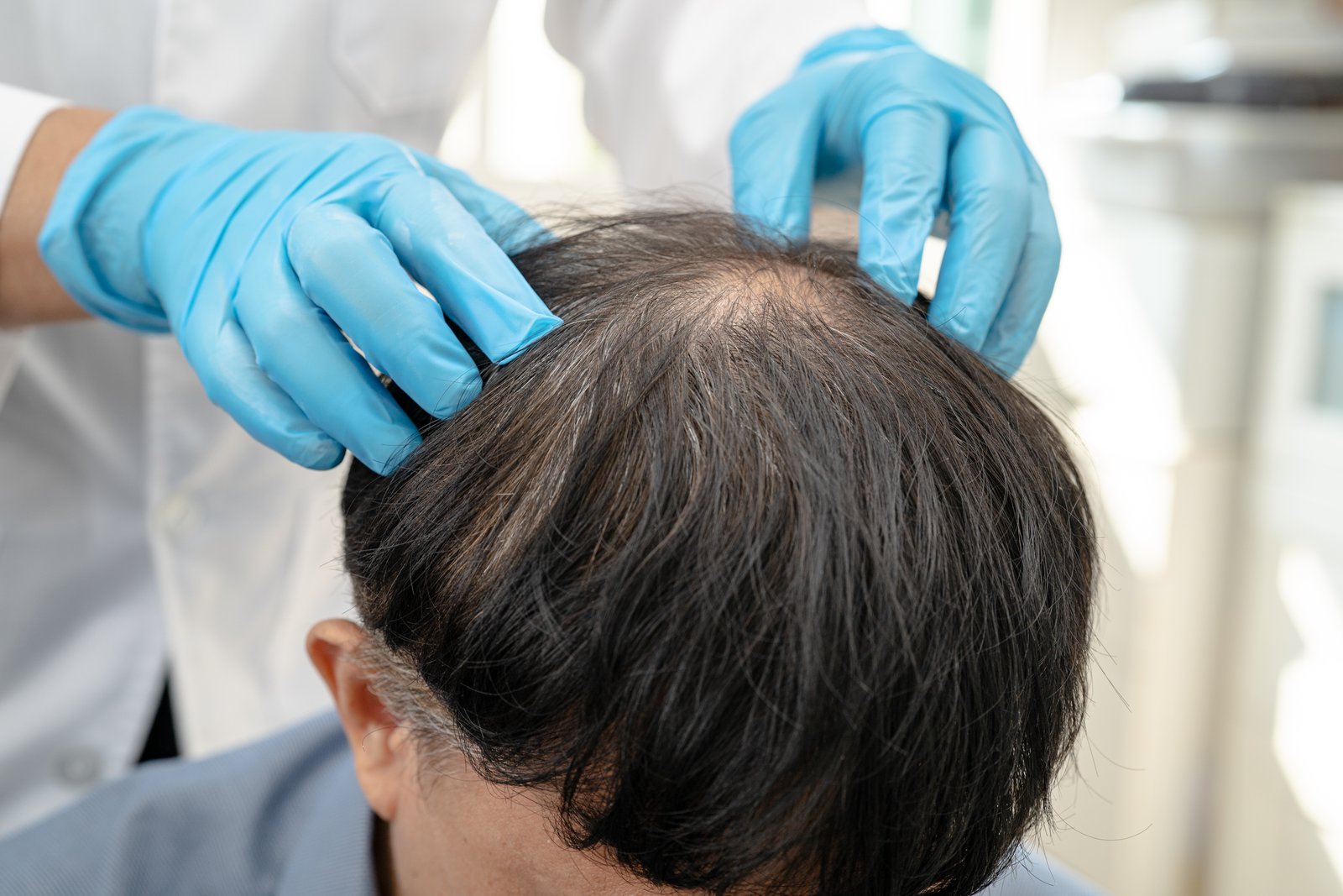 Scalp Treatment in Punjabi Bagh at Skinfollix