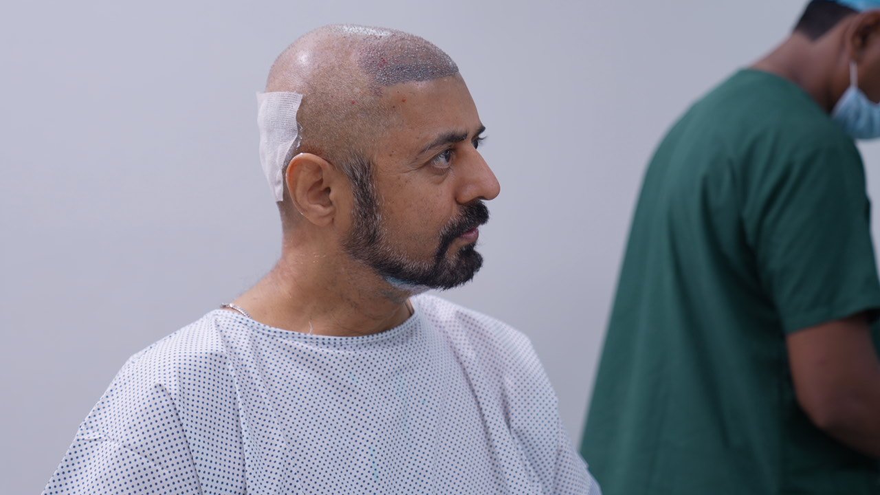 Scarring hair transplant in Delhi at Skinfollix