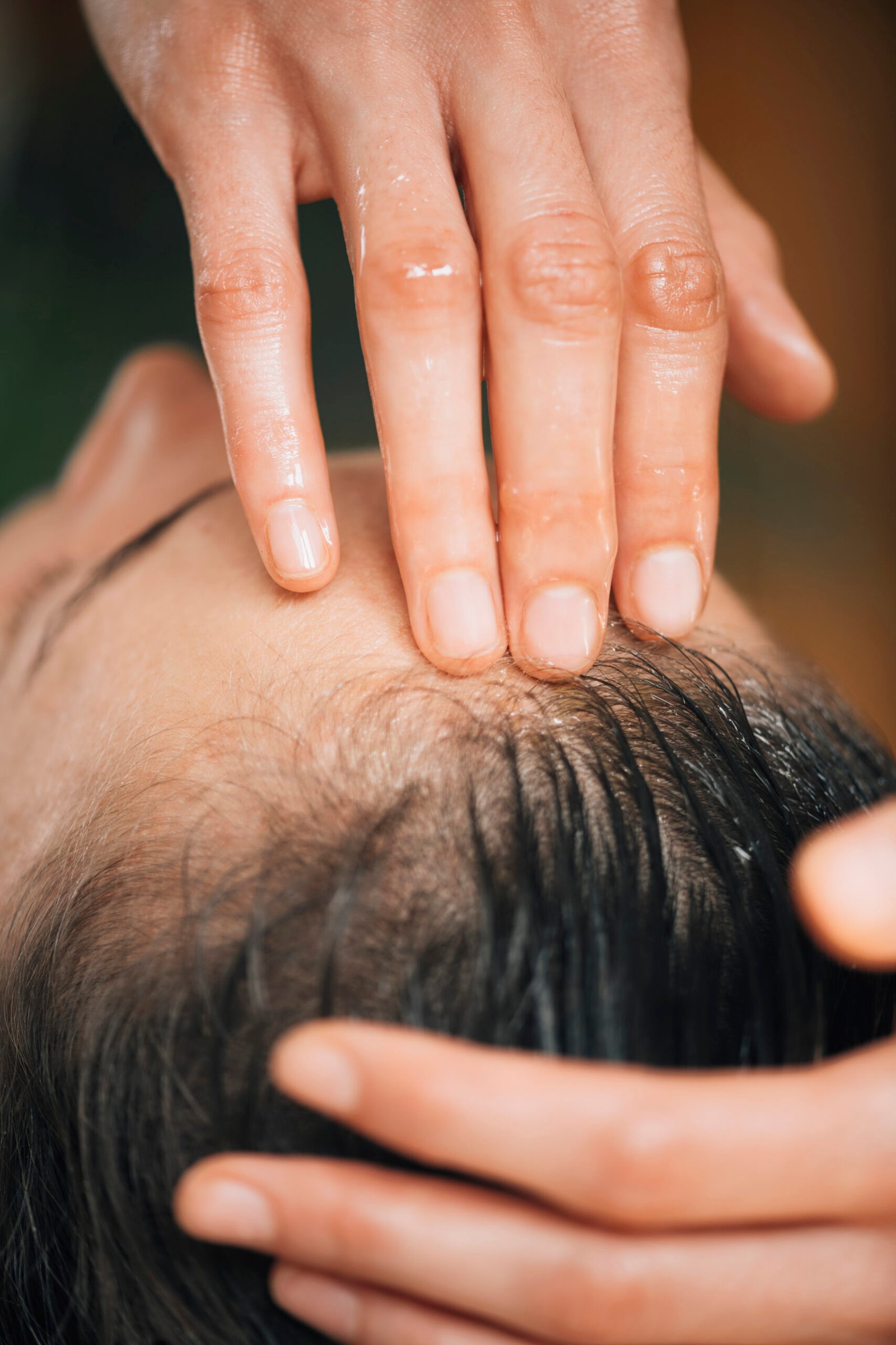 Seborrheic dermatitis with scalp scaling and irritation