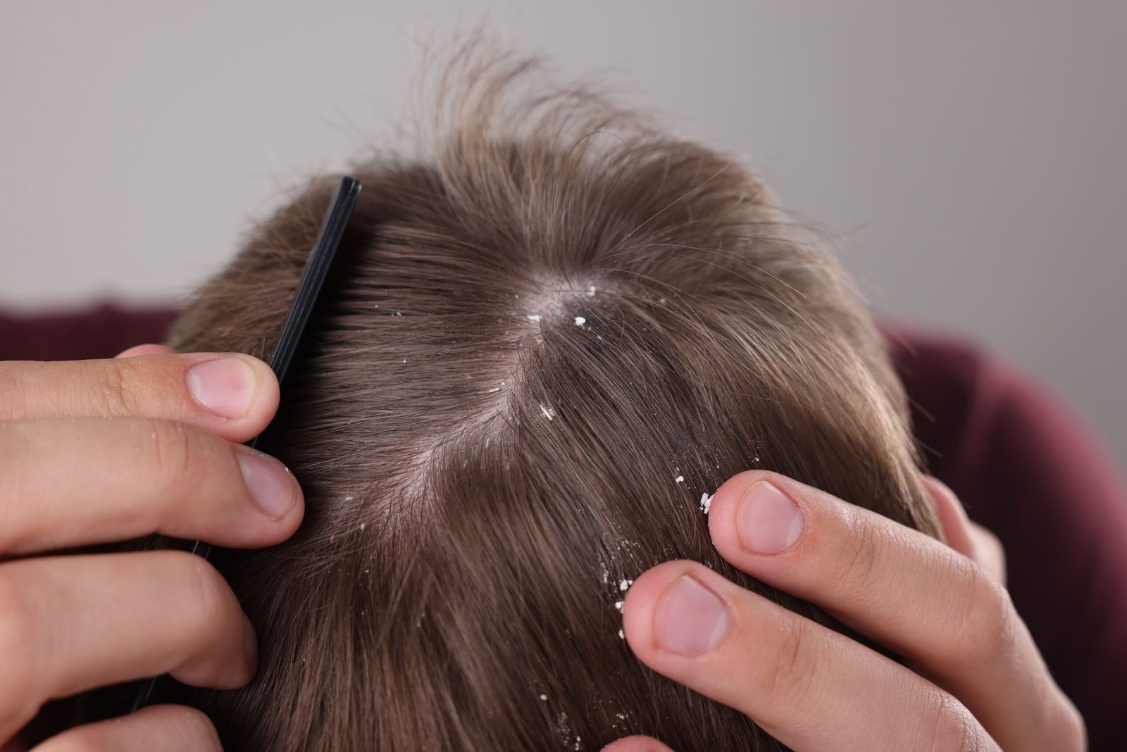 Seborrheic dermatitis with scalp scaling and irritation