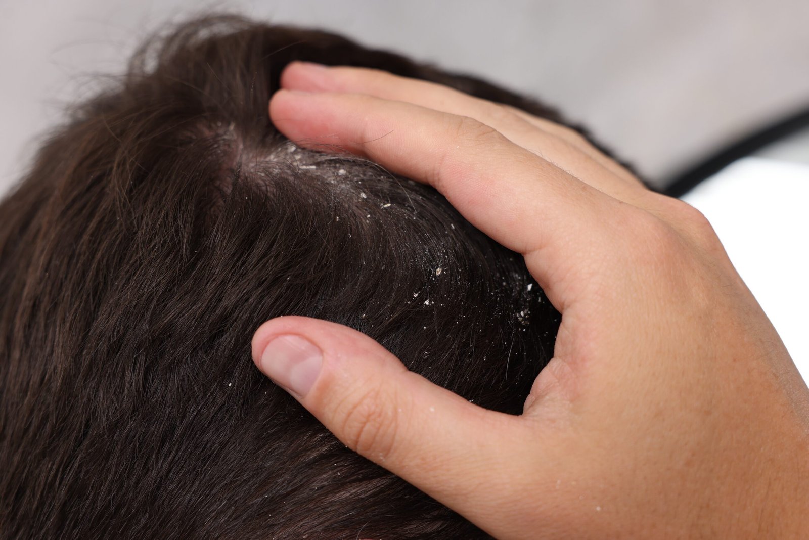 Severe dandruff with extensive scalp scaling